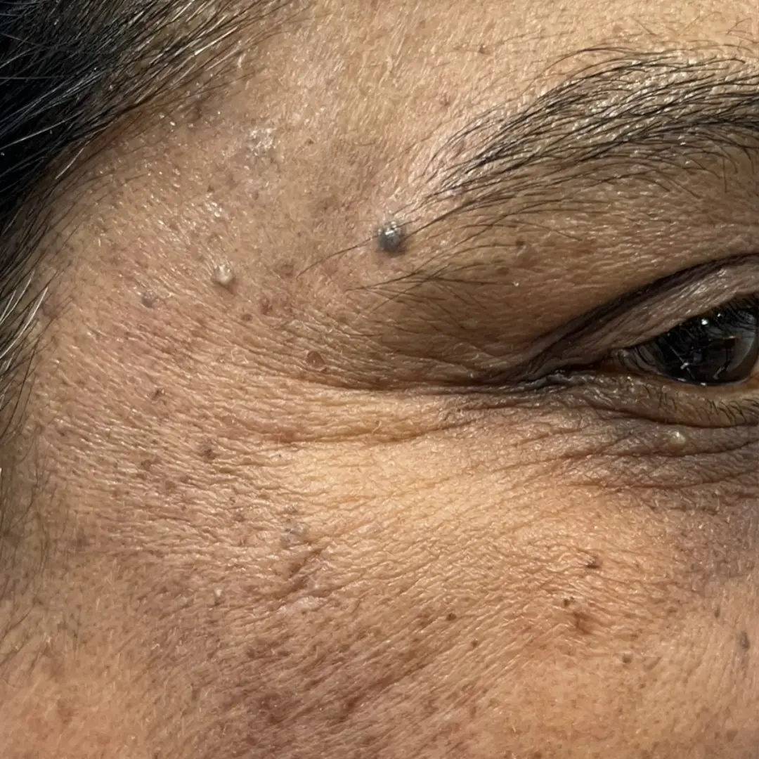 Before Skin Rejuvenation