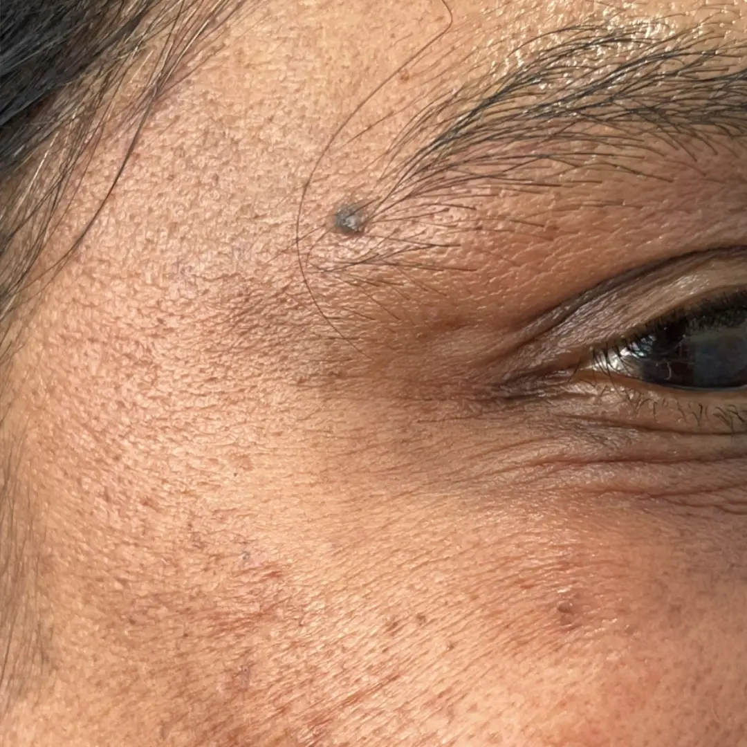 After Skin Rejuvenation