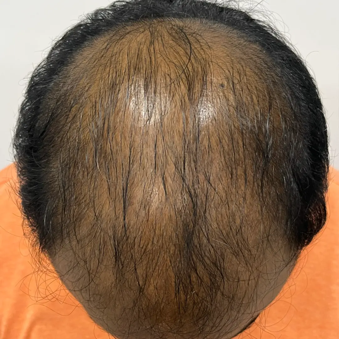 After Hair Restoration