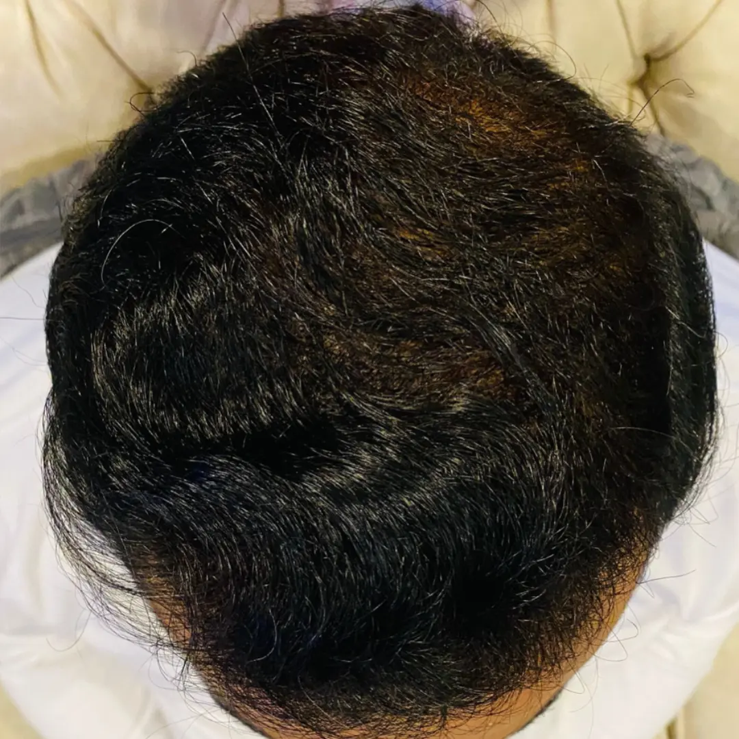 Before Hair Restoration