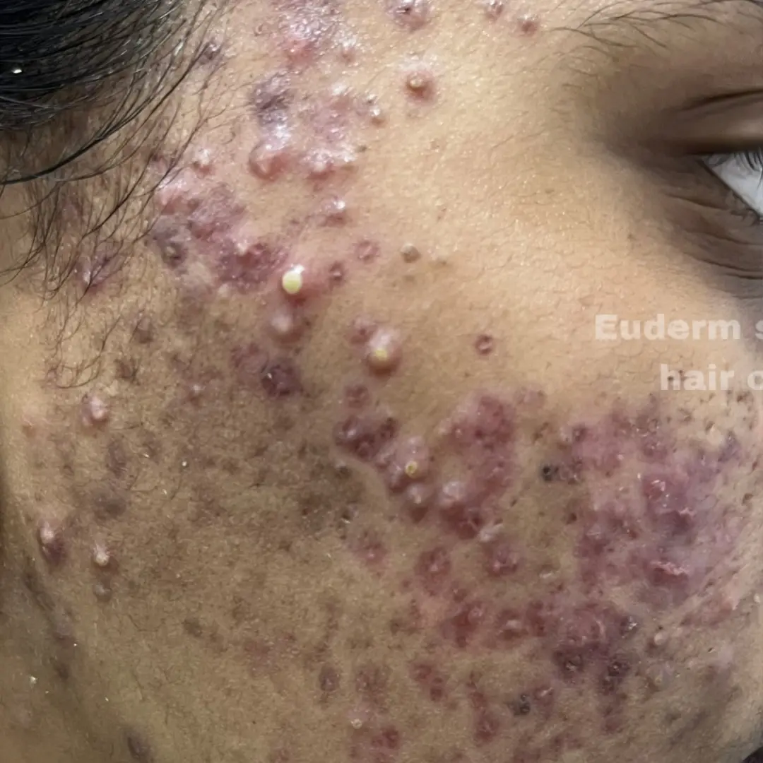 Before Acne Treatment