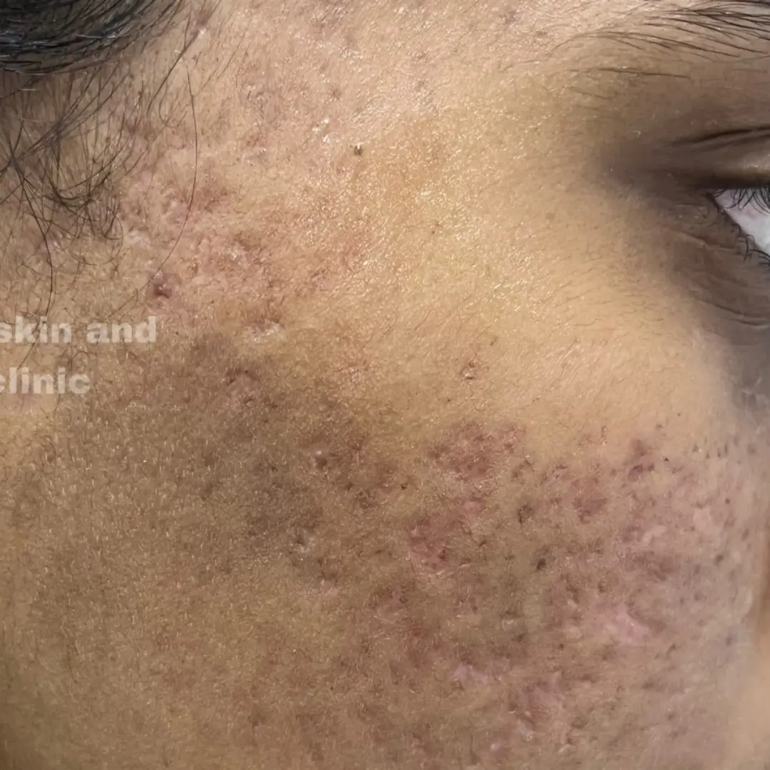 After Acne Treatment